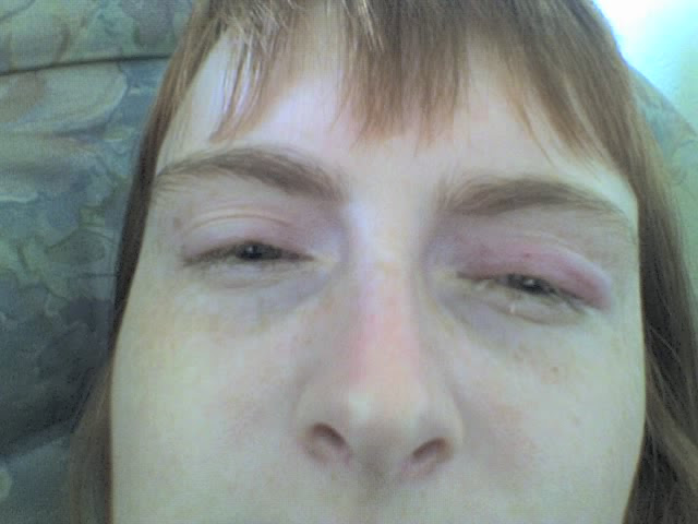 A woman with sore eyes lying on a sofa. She has bruises and is very pale. Photo of Catherine Green from SpookyMrsGreen.com recovering from eyelid rotation surgery to relieve symptoms of Lymphedema-distichiasis syndrome. SpookyMrsGreen.com mindful parenting and modern pagan lifestyle blog.