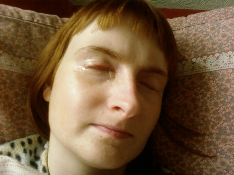 Patient recovering from eyelid rotation surgery at NHS hospital Manchester Royal Eye Infirmary. Copyright Catherine Green of SpookyMrsGreen.com mindful parenting and modern pagan lifestyle blog.