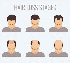 Male Pattern Baldness hair loss treatment at Oxford Online Pharmacy affiliated with SpookyMrsGreen.com mindful parenting and modern pagan lifestyle blog.